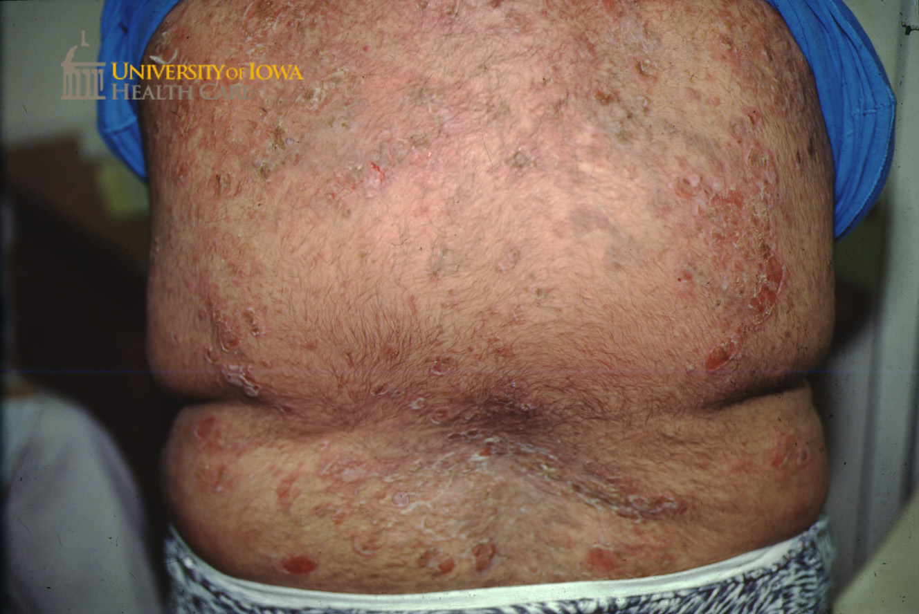 There are superficial erosions, crusting, and scales on the back. (click images for higher resolution).
